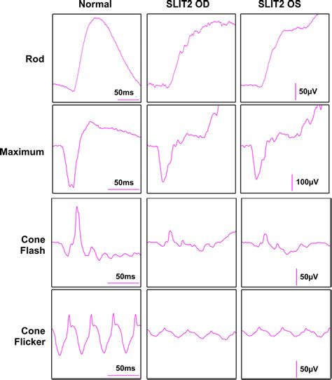 Electroretinogram: Full field electroretinogram results performed using ...