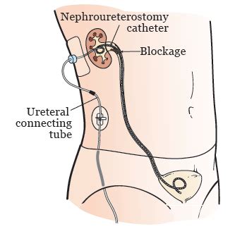 Nephrostomy Tube Placement