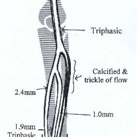 Illustrated diagram of left lower limb arterial duplex scan showing ...