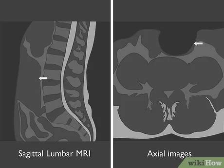 Does Lumbar Mri Include Sacrum - mapasgmaes