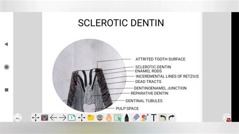 Sclerotic Dentin