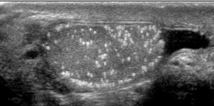 Testicular Choriocarcinoma Ultrasound