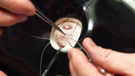 Simulated Surgery: Retinal Buckling: Placing the Sutures for a Scleral ...