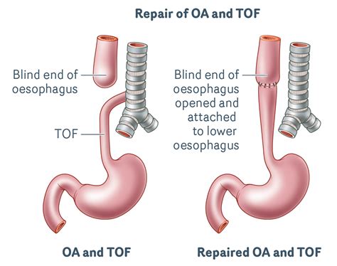 Transition Support Service : Oesophageal atresia and Tracheo-oesophageal Fistula