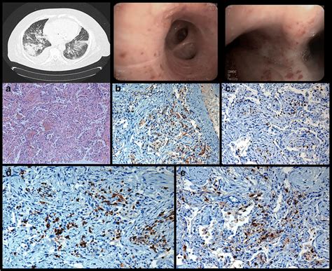 Thoracic CT scan, bronchoscopy images: Striking bilateral infiltrates... | Download Scientific ...