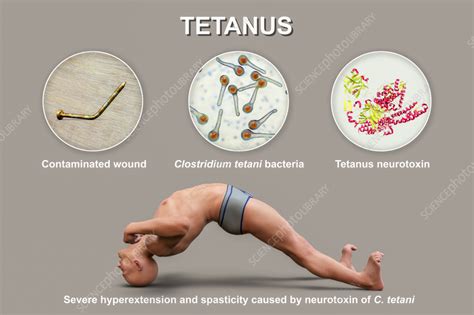 Clostridium Tetani Symptoms