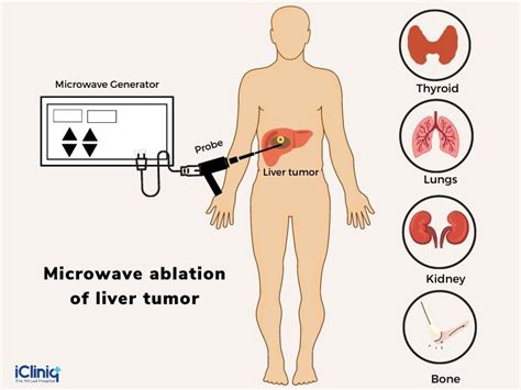 What Is Microwave Ablation?