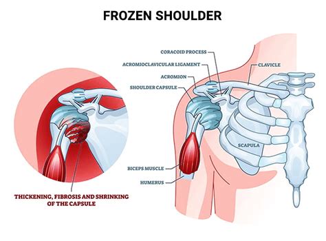 Shoulder Injury Treatment NJ | Shoulder Injury Doctors Specialists in ...