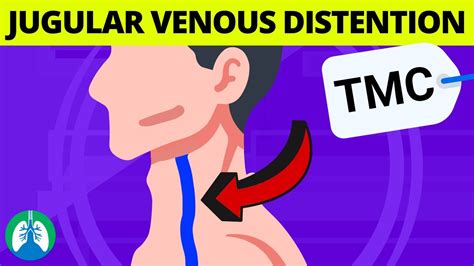 What are the Causes of Jugular Venous Distention (JVD)? | TMC Practice ...