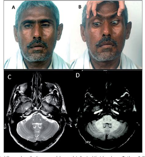 Figure 1 from Facial nuclear degeneration on MRI in bulbar onset amyotrophic lateral sclerosis ...