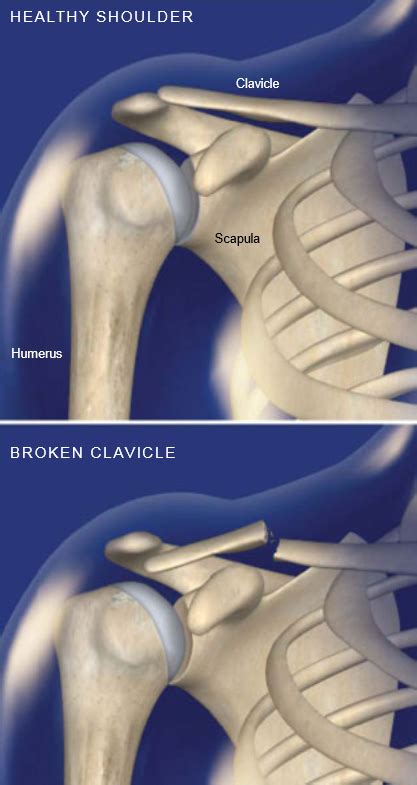 Fracture of the Collarbone (Clavicle) | Central Coast Orthopedic Medical Group