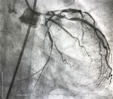 Coronary angiography shown left main (LM) stenosis with triple vessel disease (TVD). Stock Photo ...