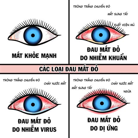 Triệu chứng đau mắt đỏ khác nhau ở mỗi người, tùy vào nguyên nhân