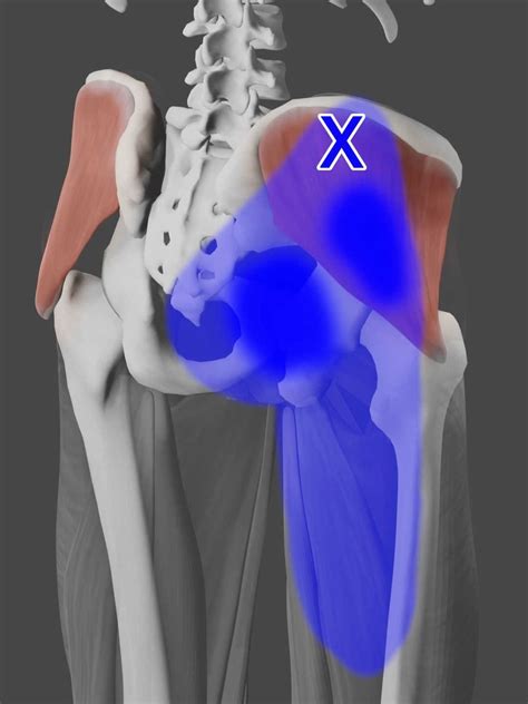 Acupuncture for Gluteus Medius Pain — Morningside Acupuncture NYC