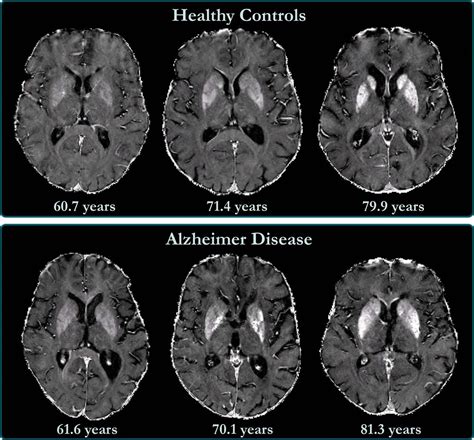 The Biomarkers of Alzheimer's Disease - LifeSensors