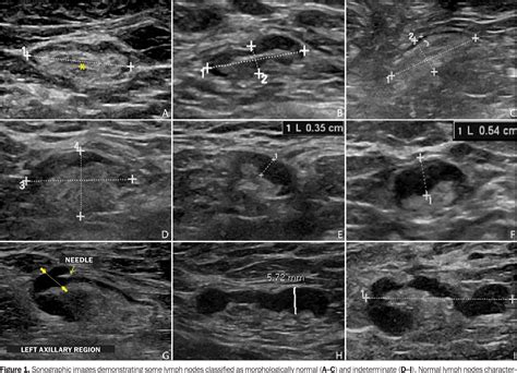 Axillary Lymph Node Cancer