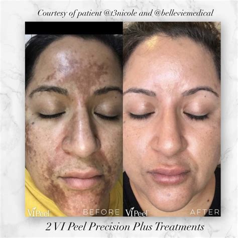 Are you ready for a VI Peel? | Cynthia Golomb, MD | Dermatology Boutique