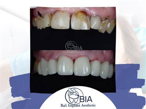 Emax Crowns - Bali Implant Aesthetic (BIA) Dental Center