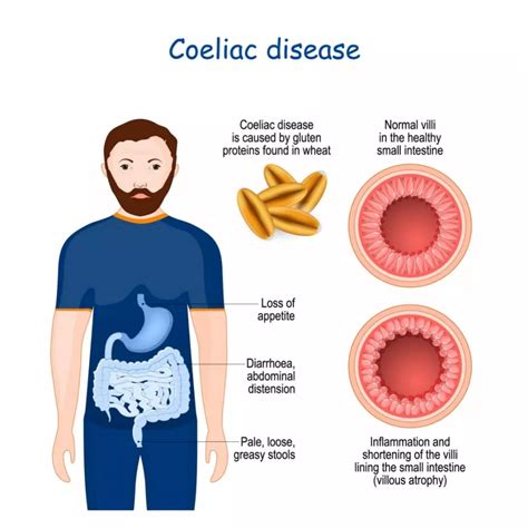 Celiac disease - NabahaKatalina