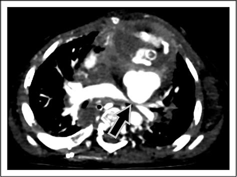 False Aneurysm of the Proximal Sano Shunt in a Patient With Hypoplastic ...