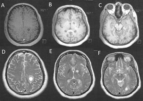 Tumefactive Multiple Sclerosis Masquerading as Cancer | British Journal ...