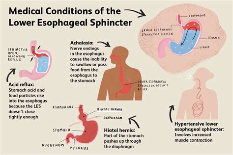 Lower Esophageal Sphincter: Anatomy, Function, Treatment