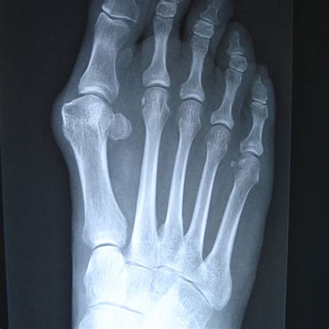 Bunions – Podiatrist Brisbane Southside | The Podiatry Practice | Orthotics, Ingrown Toenails