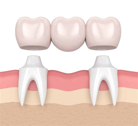 Cantilever Dental Bridge