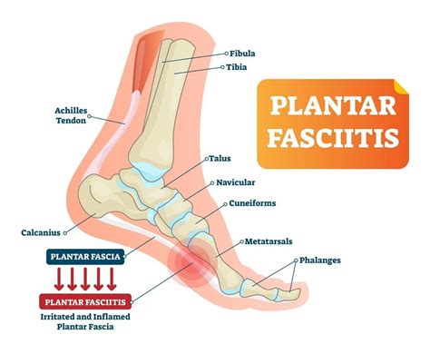 Talus Contusion