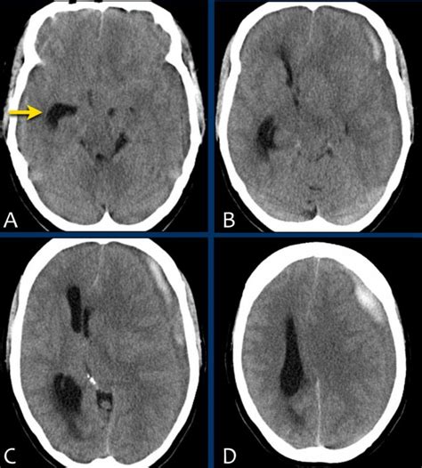 The Radiology Assistant : Traumatic Intracranial Hemorrhage