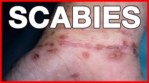 Scabies Signs Symptoms