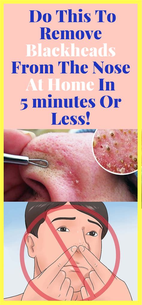 Daily Health Advisor : Do This To Remove Blackheads From The Nose At Home In 5 minutes Or Less!