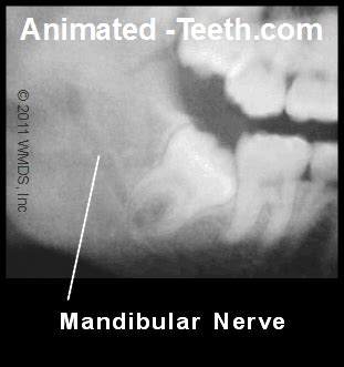 Lingual Paresthesia From Nerve Injection