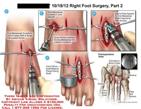 AMICUS Illustration of amicus,surgery,foot,metatarsal,cuneiform,cannulated,screw,Trei-X,bone ...