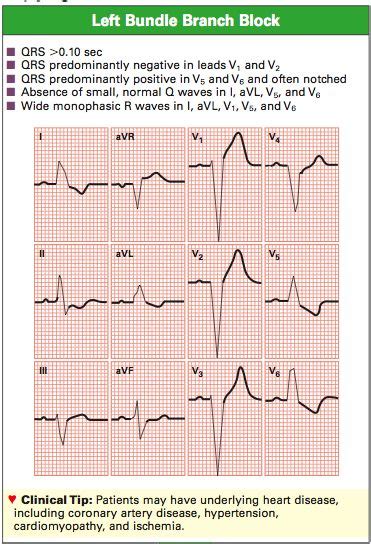 LBBB criteria | ECG teaching resources | Pinterest