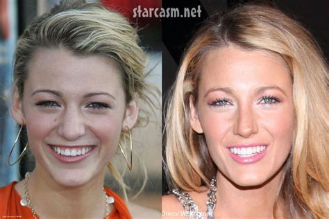 Blake Lively - Before and After Nose Job