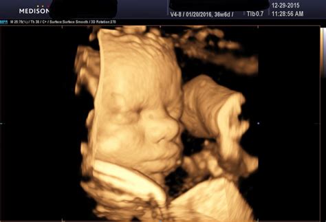 The Evolution Of Ultrasounds - 2D-3D-4D-5D Compared