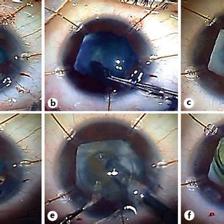 Left eye before surgery. Band keratopathy, posterior synechiae and... | Download Scientific Diagram