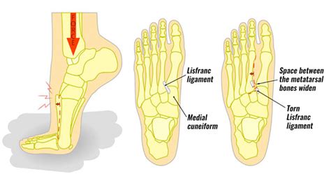 Lisfranc Injury - Symptoms, Causes and Treatment