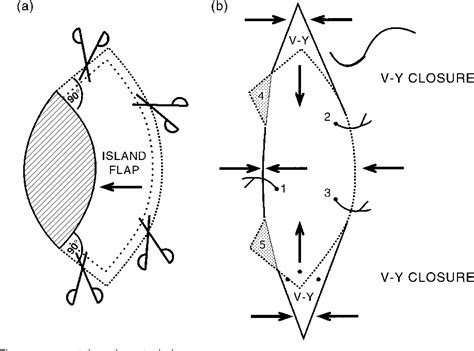 Figure 4 from THE KEYSTONE DESIGN PERFORATOR ISLAND FLAP IN ...