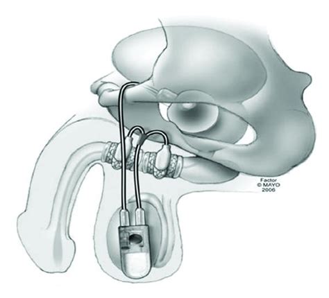 Graphical representation of the tandem-cuff artificial urinary ...