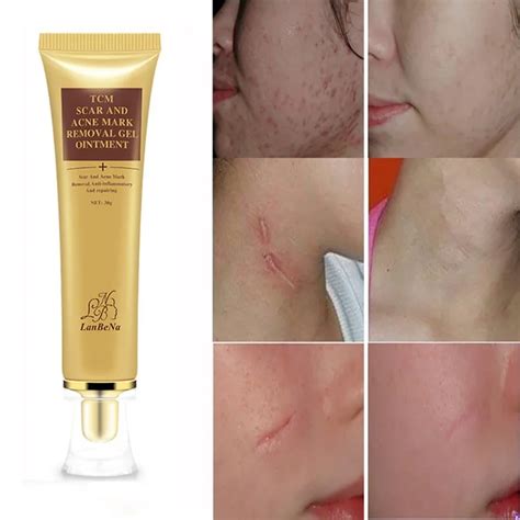 Face Beauty Scar Removal Cream Skin Repair 30ml Face Cream Blemish ...