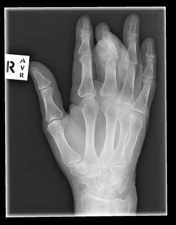 Gouty arthropathy | Image | Radiopaedia.org