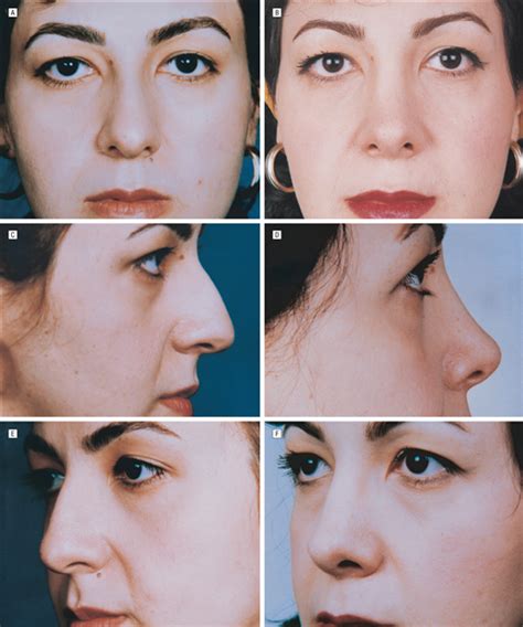 A New Technique for Reconstruction of the Nasal Dorsum | JAMA Facial Plastic Surgery | The JAMA ...