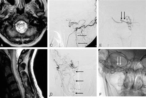 A 72-year-old woman with progressive tetraparesis. A and B, MR images ...