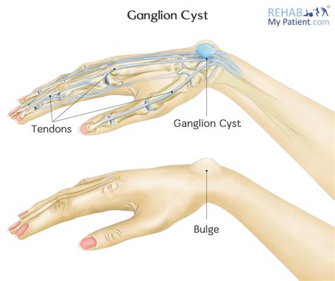 Ganglion Cyst | Rehab My Patient