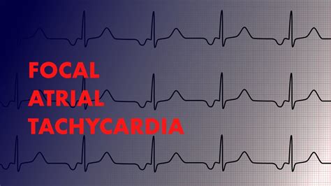 Focal Atrial Tachycardia - EKG Interpretation - MEDZCOOL - YouTube