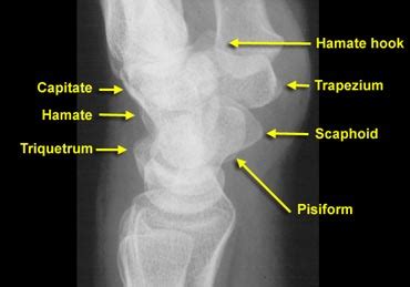 The Radiology Assistant : Wrist - Carpal instability