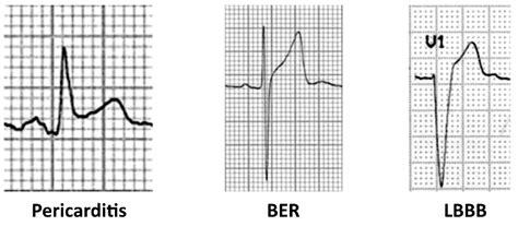 The ST Segment • LITFL • ECG Library Basics