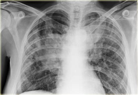 Interstitial Pneumonia X Ray